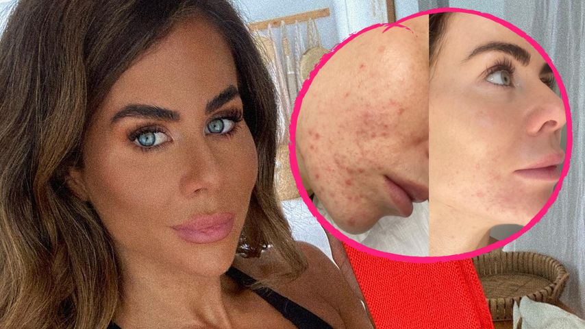 "Hart für mich": Fitness-Mom Sophie Guidolin zeigt ihre Akne