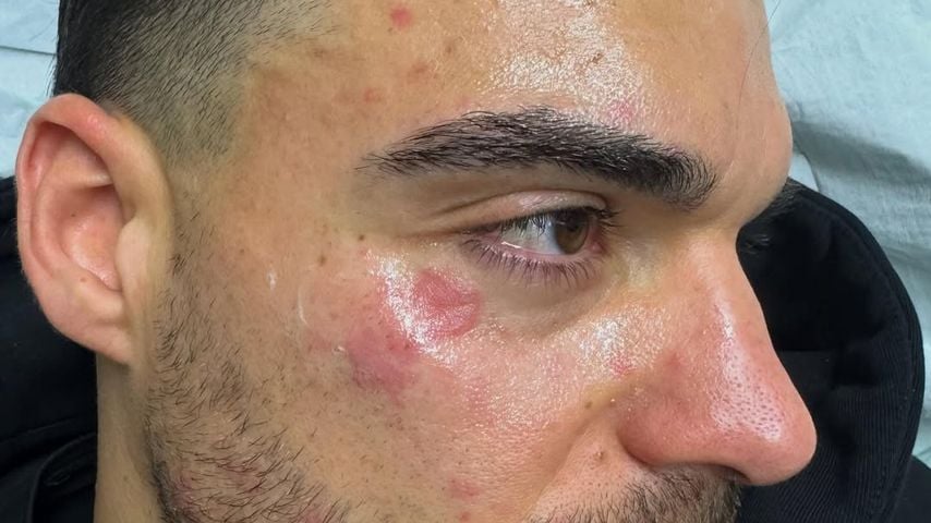 Stefano Zarella nach Küchenunfall 2025