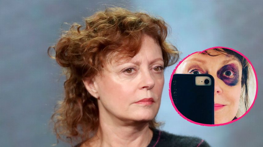 Riesiges Veilchen: Was ist mit Susan Sarandon passiert?