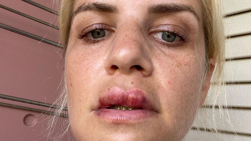 Lippe geschwollen: Susan Sideropoulos stürzte im Urlaub