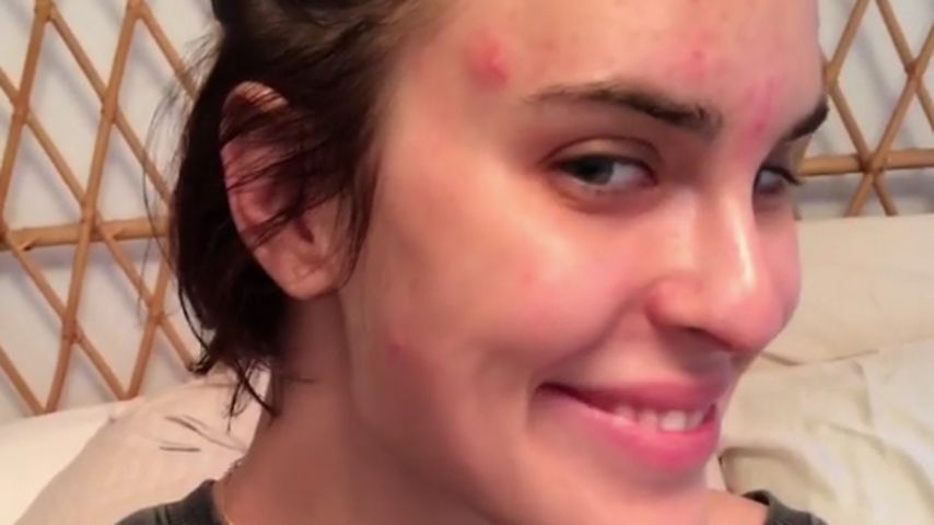 Herrlich uneitel: Tallulah Willis setzt ihre Akne in Szene