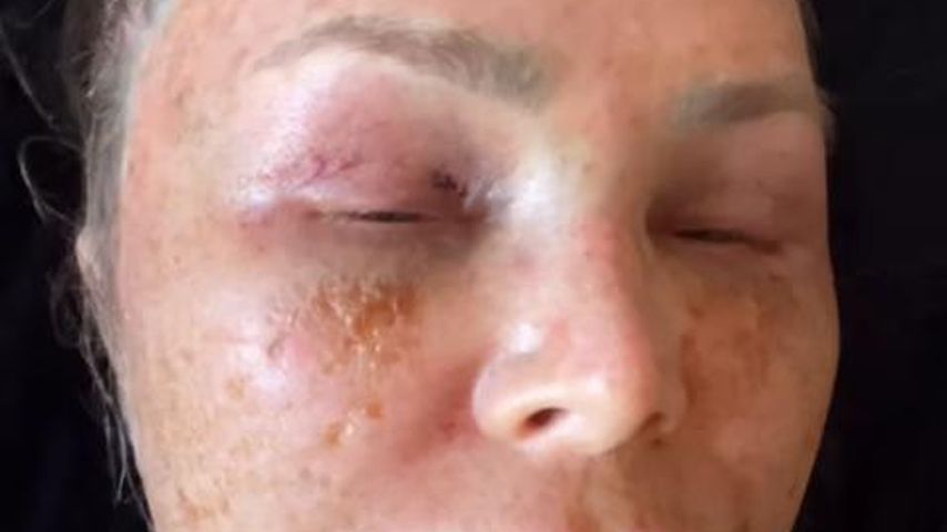 Tamra Judge nach einem Beauty-Eingriff im September 2024