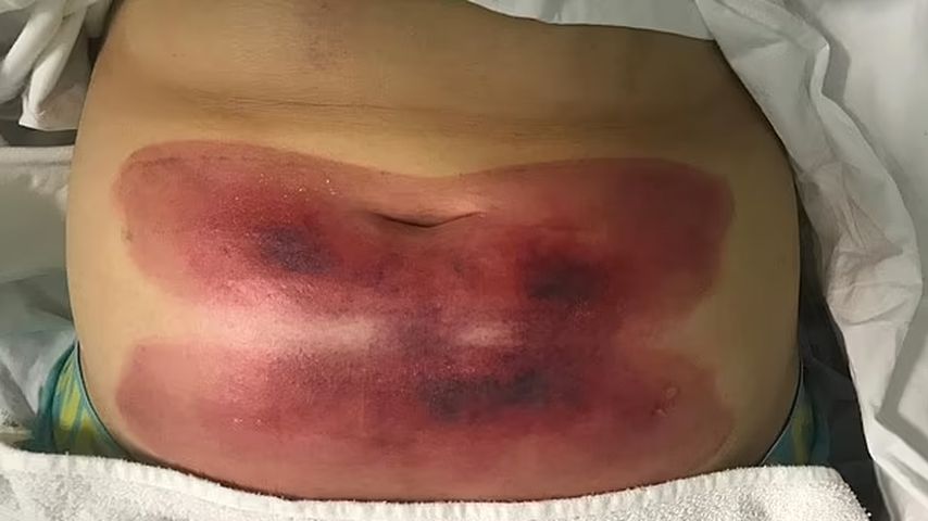 Taylor Penroses Bauch nach einer Beauty-Behandlung
