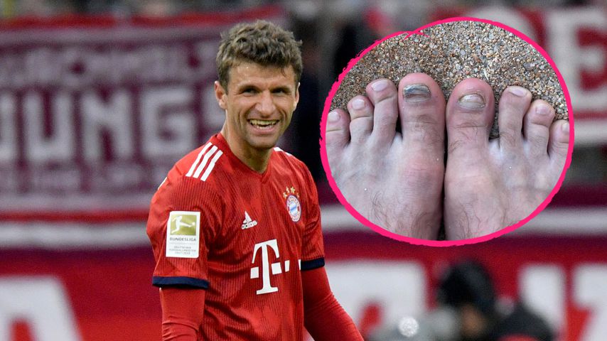 Kickerleiden: Thomas Müller witzelt über kaputte Fußnägel