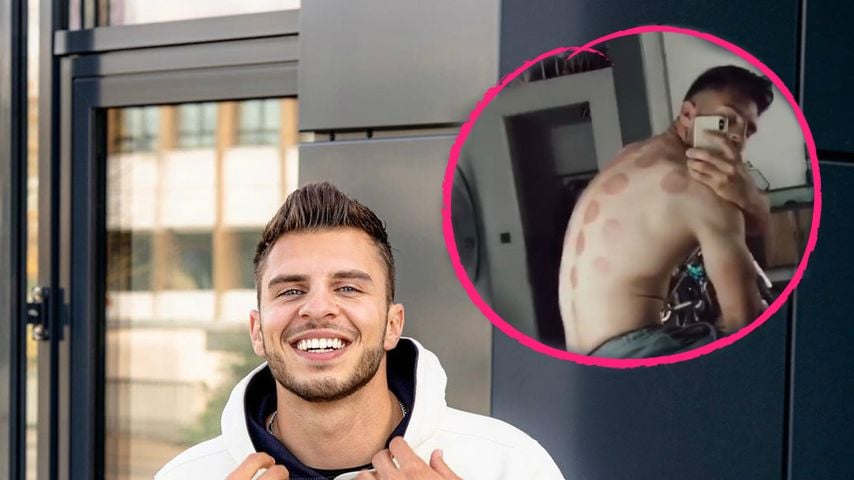 Heftige Abdrücke: Tim Stammberger wurde geschröpft