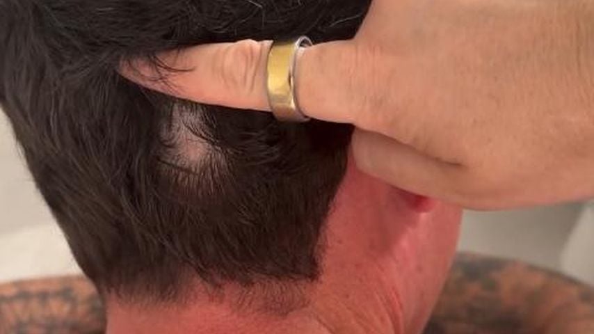 Influencer Tobias Wolfs kreisrunder Haaraufall