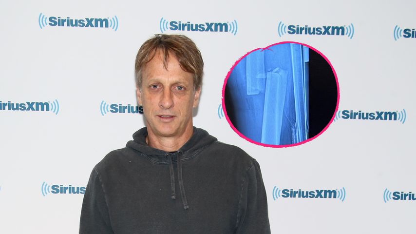 Gebrochener Oberschenkel: Tony Hawk hatte üblen Skate-Unfall