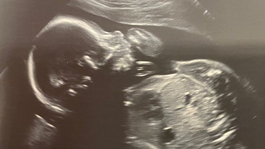 Ultrallschallaufnahme von Brian McFaddens ungeborenem Baby