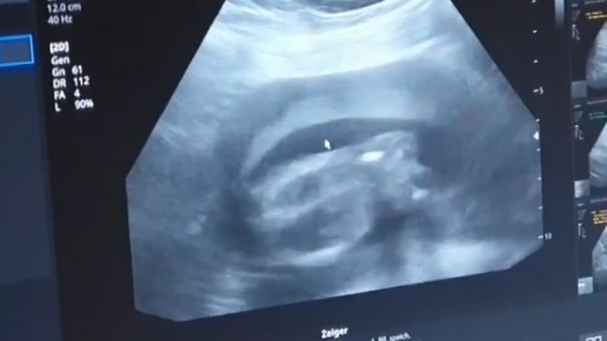 Ultraschallbild von Dennis Pohlens zweitem Baby