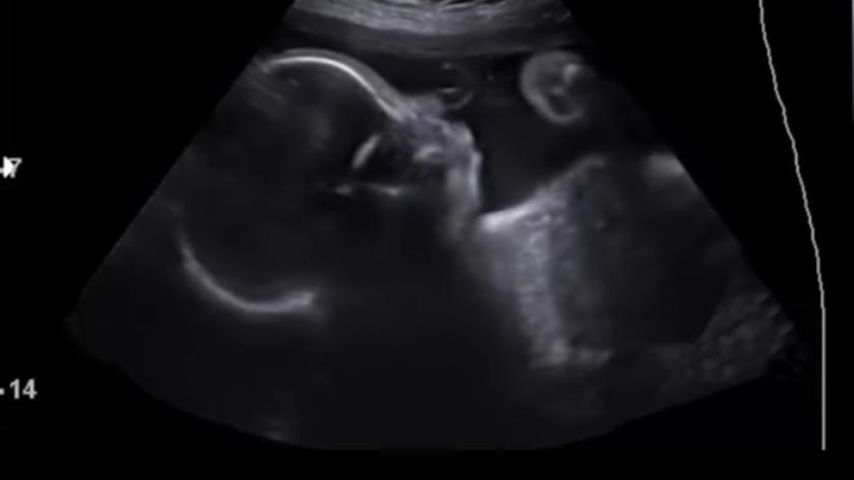 Ultraschall von Labrinths Baby
