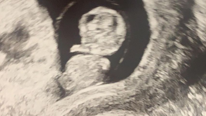 Ultraschallbild von Alex Reids Baby