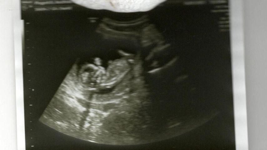 Ultraschallbild von Anuthida Ploypetchs Baby