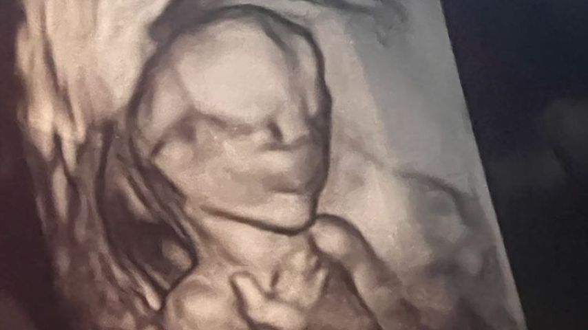 Ultraschallbild von Chrissy Teigens Baby