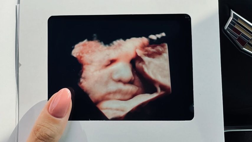 Ultraschallbild von Fiona Erdmanns Baby