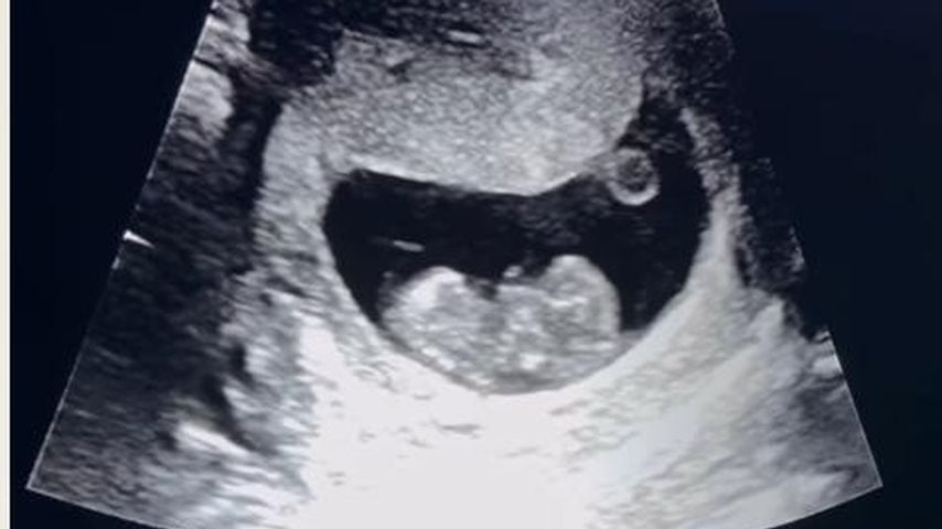 Ultraschallbild von Holly Hagans zweitem Baby