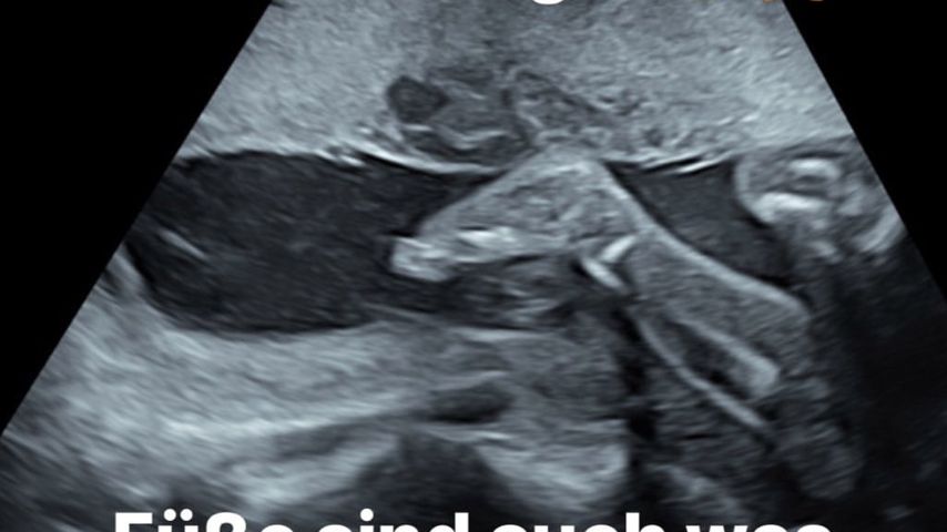 Ultraschallbild von Iris Aschenbrenners Baby
