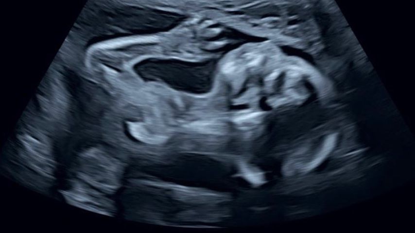Baby von Jana Schölermann auf einem Ultraschallbild, September 2021