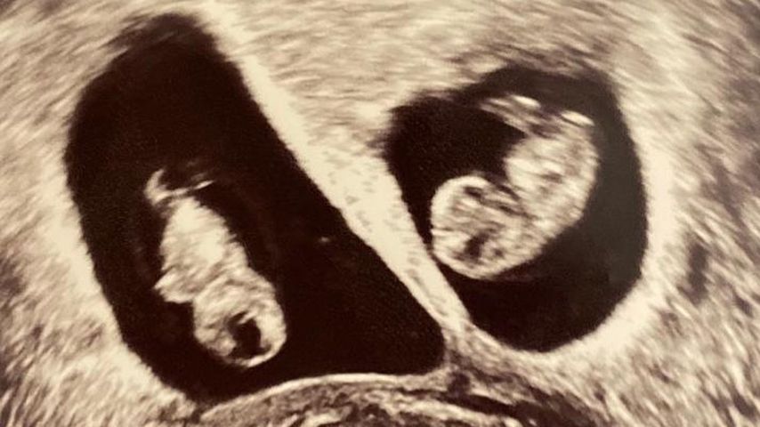 Ultraschallbild von Josephine Welsch' Zwillingen