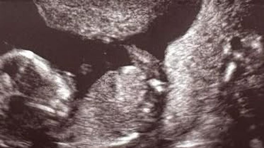 Ultraschallbild von Lennart Borcherts Baby