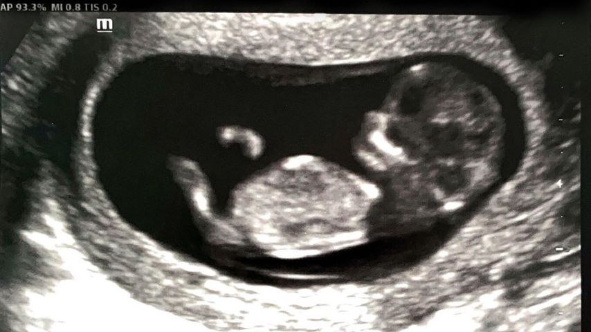 Ultraschallbild von Paul Nassifs Baby
