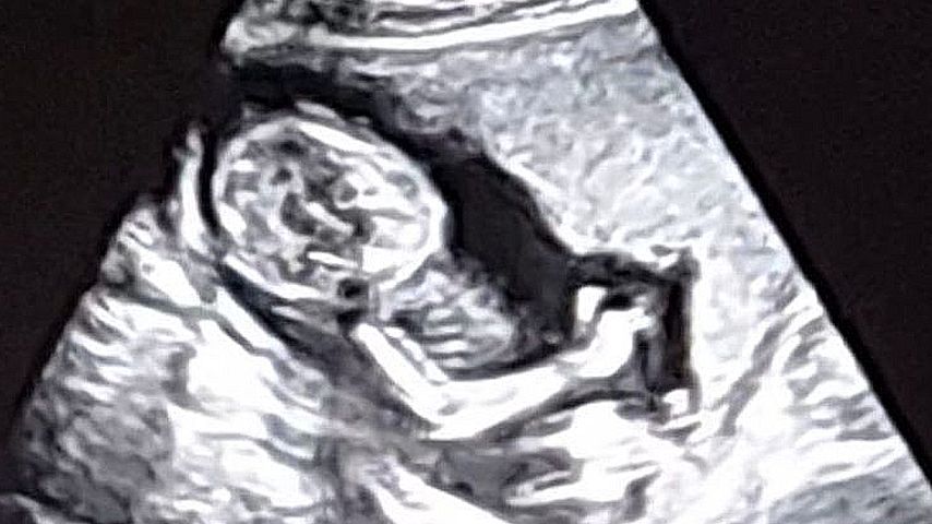 Ultraschallbild von Saskia Atzerodts Baby