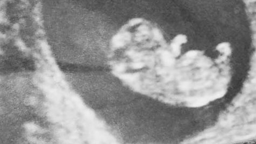 Ultraschallbild von Shaquil Barretts Baby