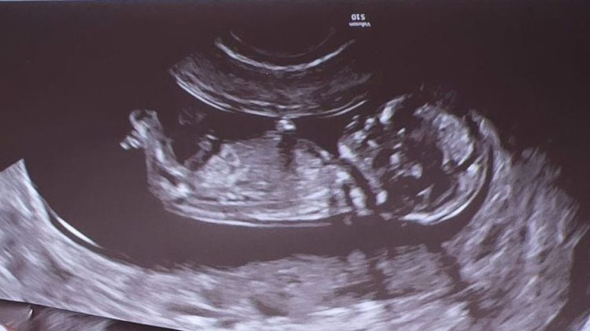 Ultraschallfoto von Anne Wünsches Baby Anfang und Mitte Dezember 2021