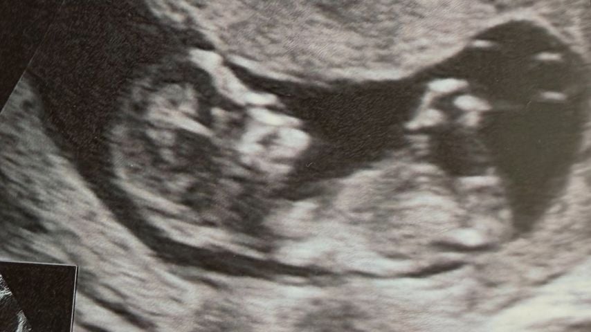 Ultraschallfoto von Laura Woods' Baby