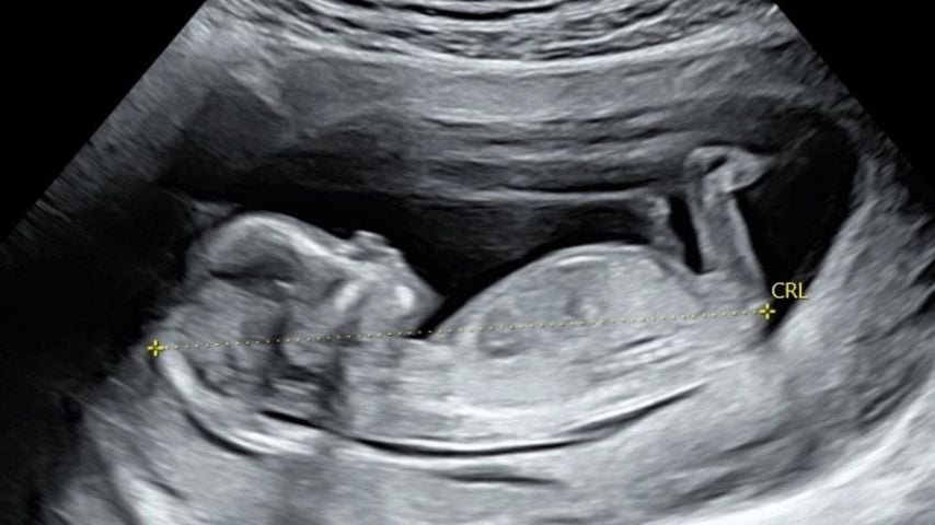 Ultraschallfoto von Nick Viall und Natalie Joy