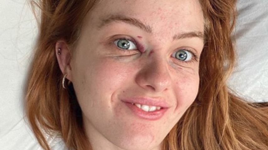 Vanessa Tamkan nach ihrem Unfall mit dem Schraubenzieher, April 2020