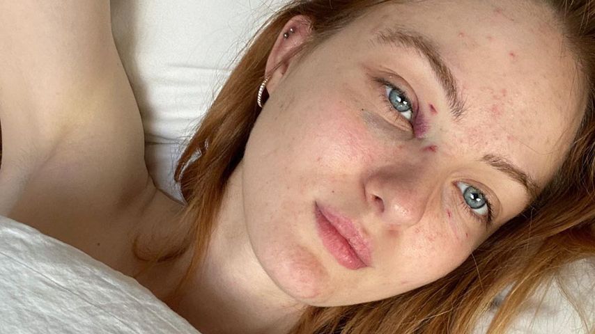Vanessa Tamkan hat sich Schraubenzieher ins Gesicht gerammt!
