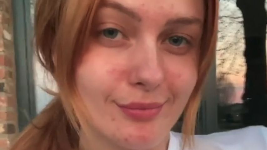 Hautprobleme: Vanessa Tamkan lernte, mit Makeln umzugehen