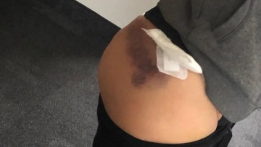 Vanja Rasova nach ihrer Fettabsaugung