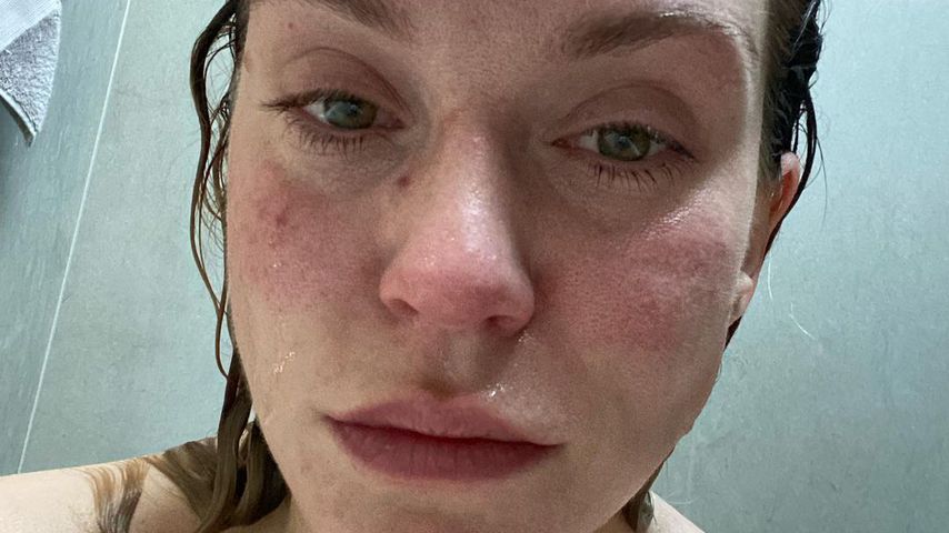 Total aufgelöst: Vicky Pattison hat eine Zyste am Eierstock