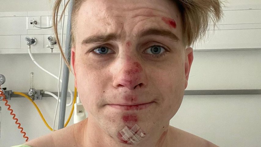 Blutiges Gesicht: Schlagerstar Vincent Gross im Krankenhaus