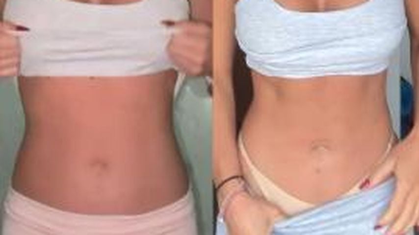 Vorher-Nachher-Bild von Emma Fernlund nach ihrem Wasserfasten