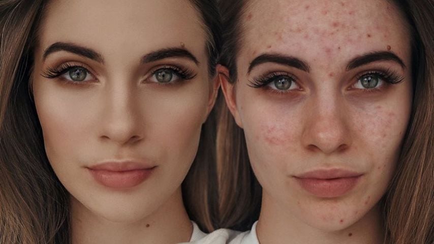 Influencerin Lisa-Marie Schiffner steht zu Hautproblemen