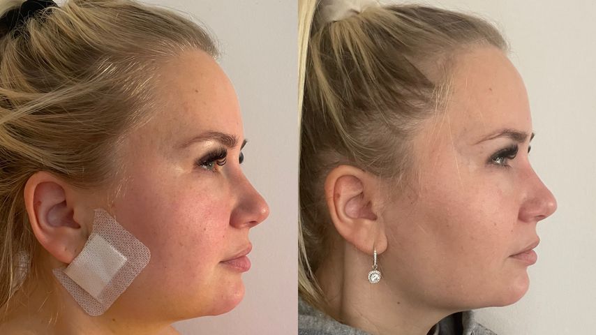 Vorher-Nachher-Bild von Marlisas Wangen-OP