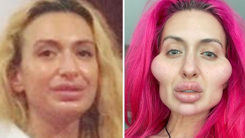 Wangenfiller-Sucht: So sah Anastasiia Pokreshchuk vorher aus