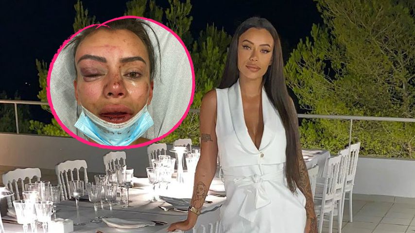 Schlimme Bilder: Instagram-Model von Partygast verprügelt