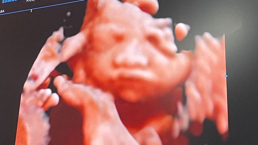 3D-Ultraschallbild von Yeliz Koc und Jimi Blue Ochsenknechts Baby