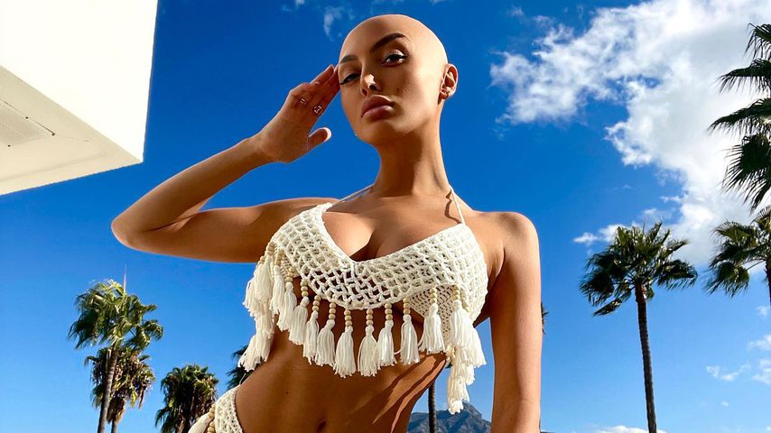 Wegen Alopezie: "Ex on the Beach"-Star verlor alle Haare