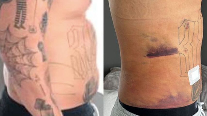 Zico Banach vor und nach seiner Fettabsaugung