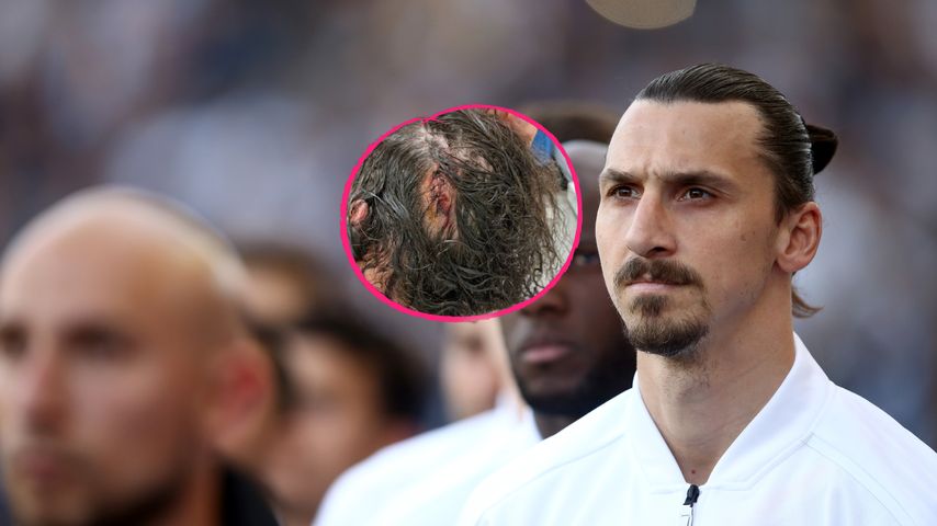 Zlatan Ibrahimovic hat eine krasse Verletzung am Hinterkopf